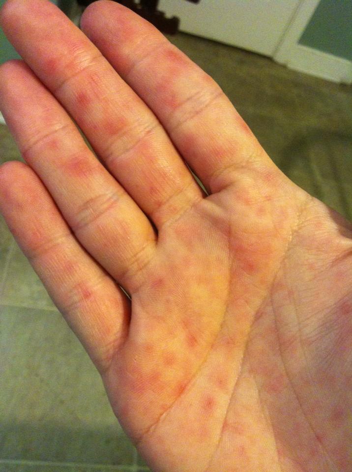 Hand, foot and mouth disease